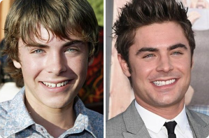 sorriso de Zac Efron antes e depois de usar aparelho dental