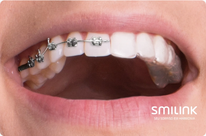 aparelho invisível alinha os dentes mais rápido que o aparelho fixo convencional