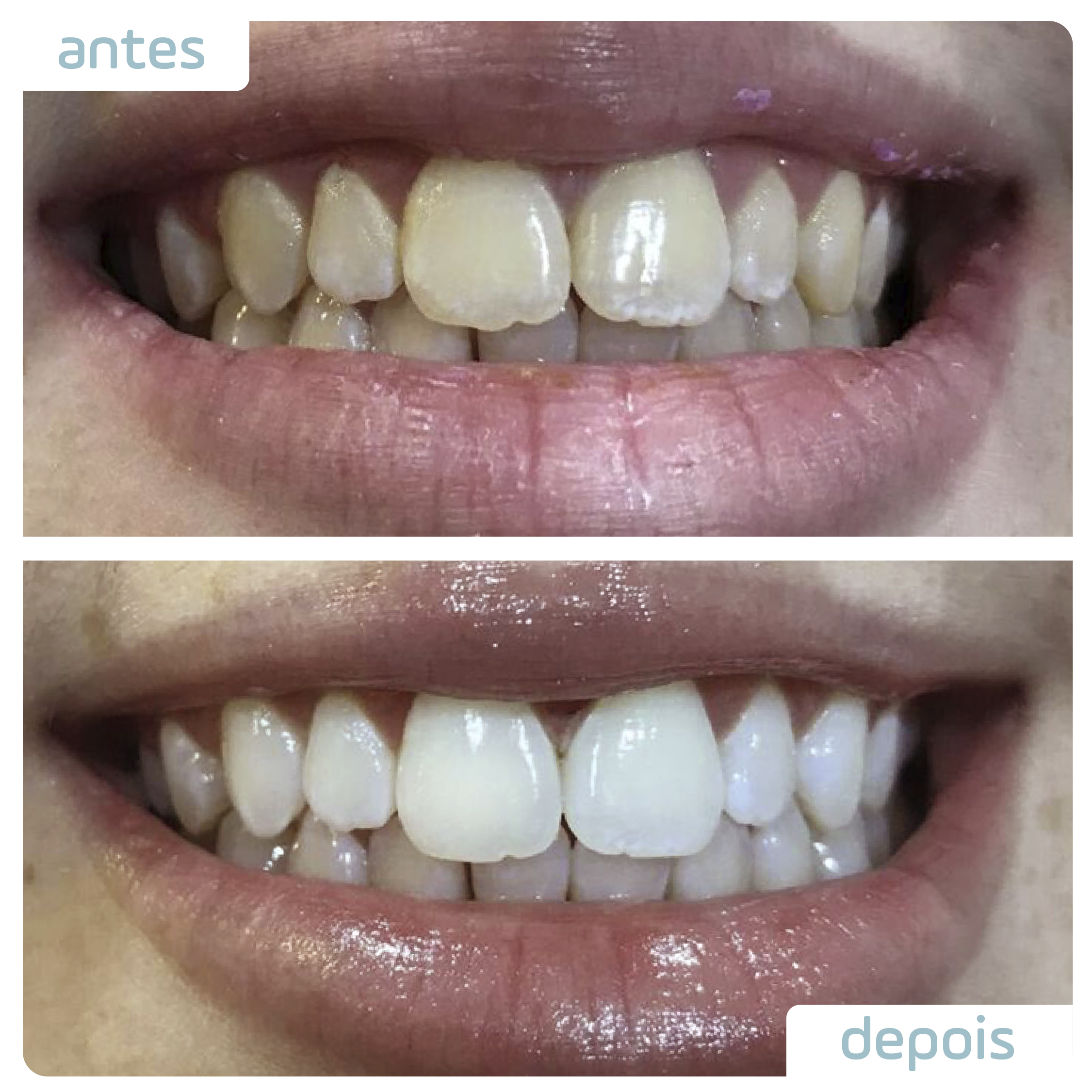 dentes tortos: antes e depois do aparelho invisível