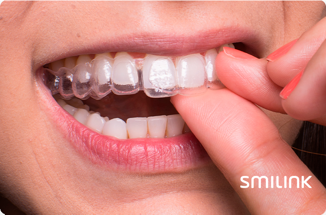 garantia de satisfação do tratamento com aparelho dental invisível
