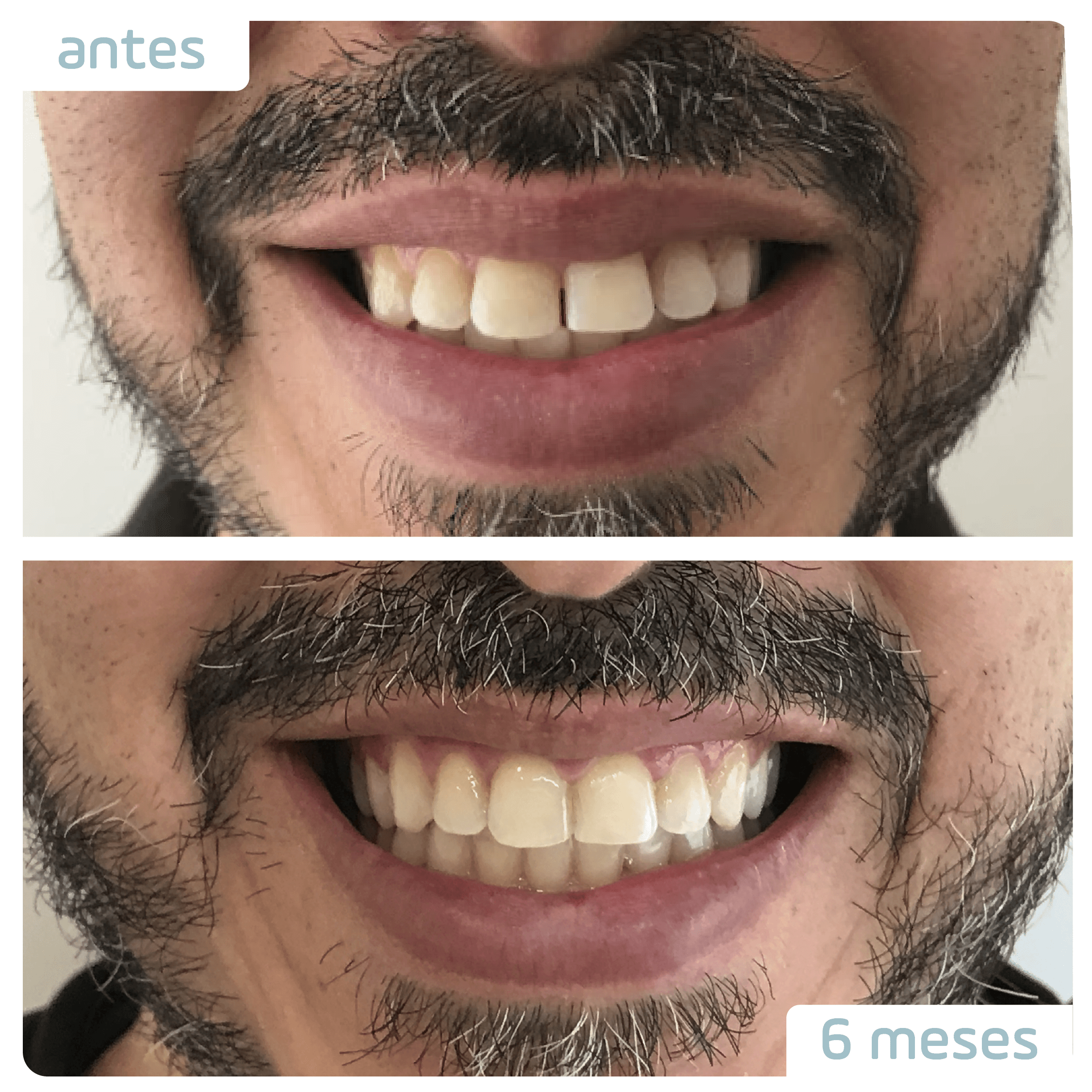 Antes e depois do aparelho invisível