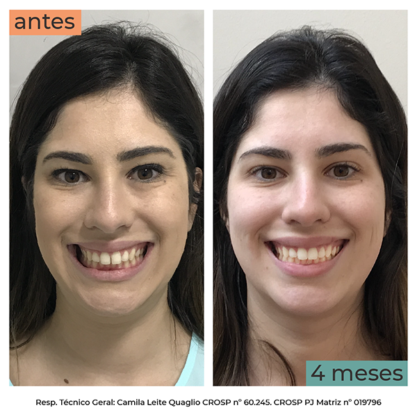 Fechamento de diastema com aparelho estético Blog Smilink Fechamento de diastema com aparelho estético Blog Smilink