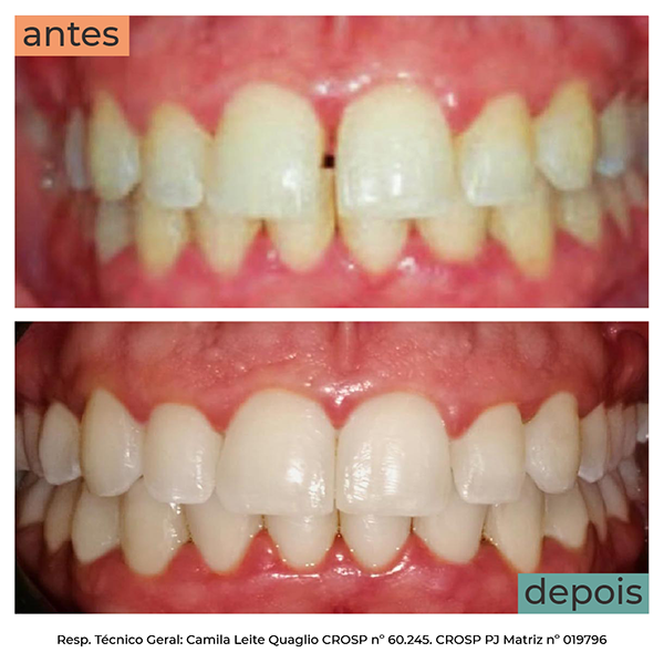 Veja o antes e depois com aparelho invisível